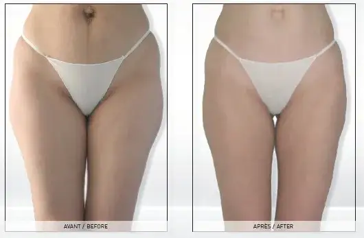 Endermologia: Gładka skóra i wymodelowana sylwetka bez skalpela?