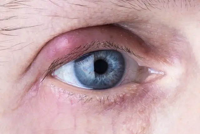 Gradówka: Jak leczyć? Domowe sposoby, leki i kiedy do lekarza.