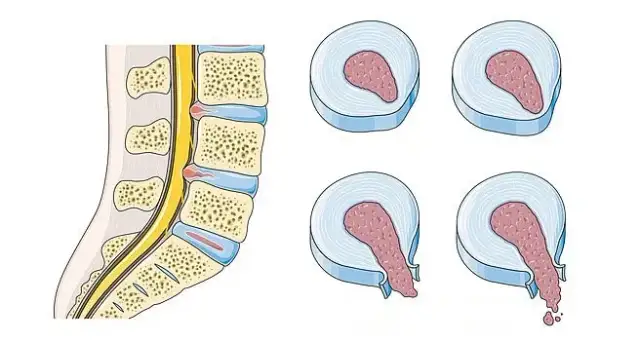 Jakich ćwiczeń unikać przy przepuklinie kręgosłupa, aby nie pogorszyć bólu