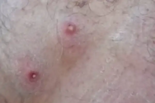 Czy pryszcze na cipce są normalne? Zrozum, co może je powodować