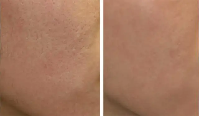 Peeling węglowy co daje? Efekty, korzyści i przeciwwskazania dla zdrowej skóry