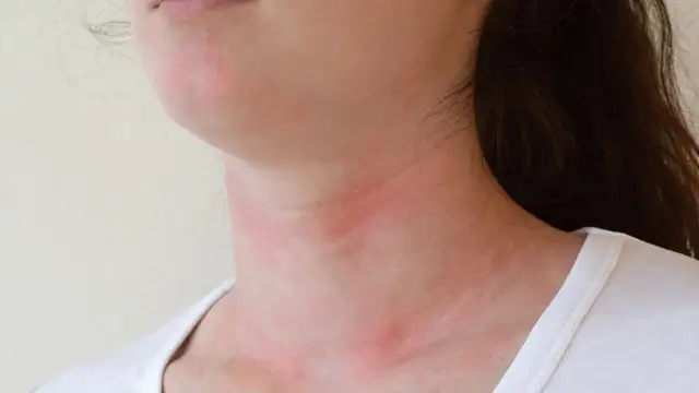 Uczulenie na curry objawy - jak je rozpoznać i uniknąć reakcji alergicznych