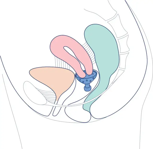 Wypadanie pochwy po porodzie: 7 objawów, które musisz znać