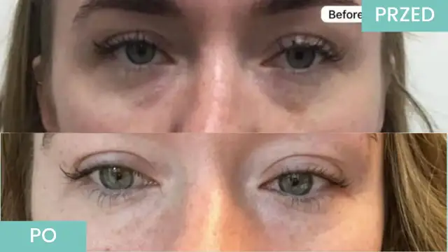 Przed i po zabiegach pod oczy. Widoczna poprawa cieni i obrzęków.