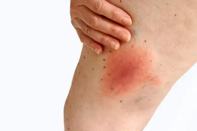 Rumień po kleszczu: Kiedy się pojawia? Objawy i co robić