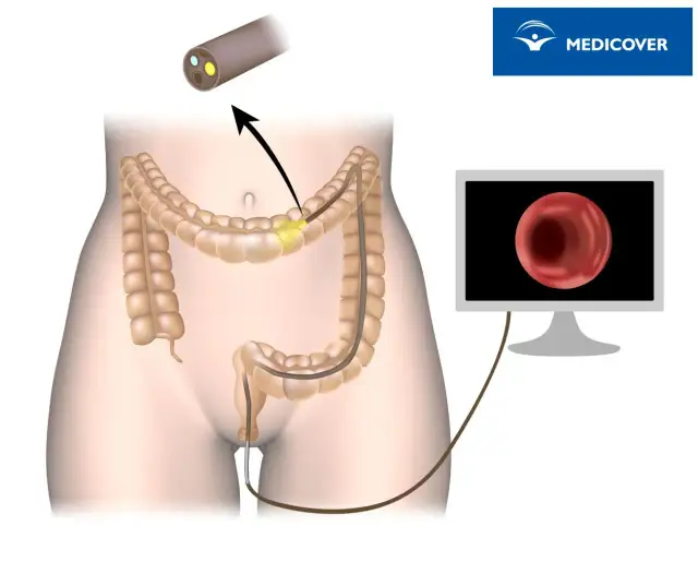 Kolonoskopia: Wszystko, co musisz wiedzieć, by podejść bez lęku