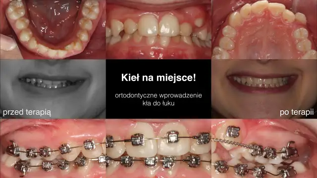 Aparat ortodontyczny: Jak wygląda zakładanie? Bez bólu!