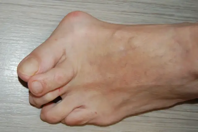 Stopa z widocznym haluksem na lewej stronie, na jasnym tle.