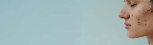 Dlaczego powstają pryszcze? Odkryj przyczyny i skuteczne rozwiązania