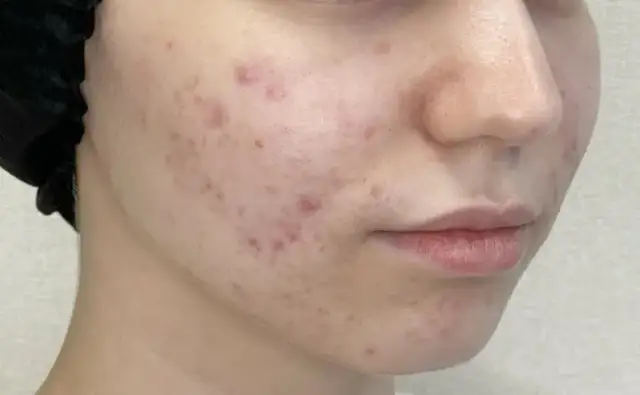 Pryszcze na policzkach: Prawdziwe przyczyny i skuteczne leczenie