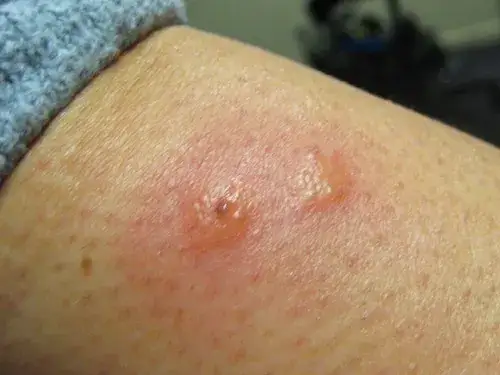 Diferencias entre ácaros y pulgas: síntomas y tratamiento de picaduras