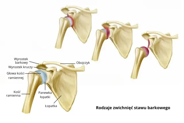 Wybity bark: skuteczne metody leczenia i rehabilitacji