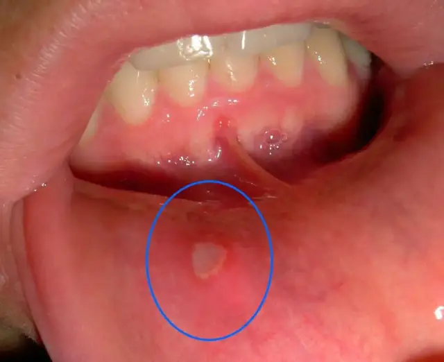 Jak wyglądają afty na dziąsłach? Rozpoznaj i szybko złagodź ból!