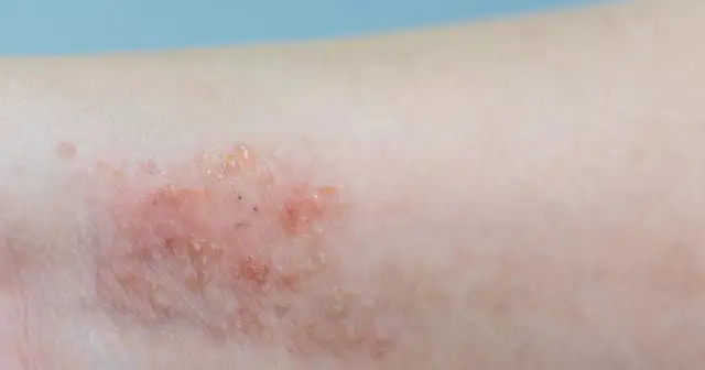 Atopowe zapalenie skóry: Co naprawdę wywołuje AZS?