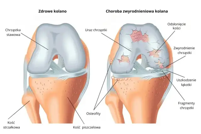 Porównanie zdrowego kolana z kolanem dotkniętym gonartrozą. Widać uszkodzenia chrząstki, odsłonięte kości i osteofity.