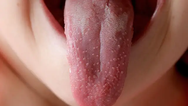 Szkarlatyna u dzieci: objawy, wysypka, malinowy język. Kiedy do lekarza?