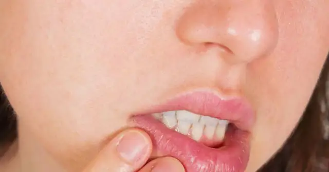Co to jest afta w jamie ustnej i jak uniknąć bólu i dyskomfortu