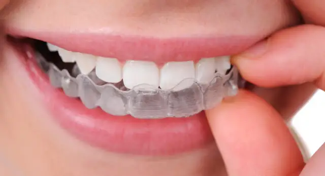 Jak naprawdę wygląda aparat na zęby? Od metalu po niewidoczne