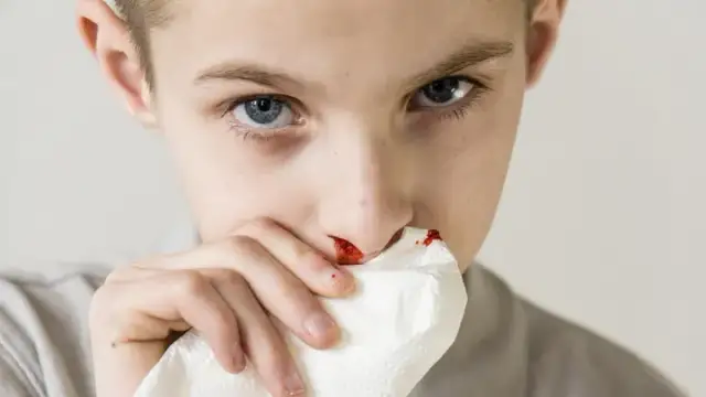 Krwotok z nosa przyczyna - poznaj najczęstsze przyczyny i objawy