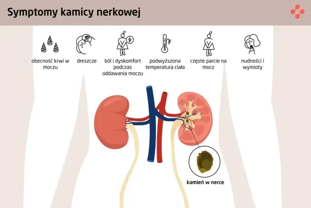 Diagnostyka kamicy nerkowej: Jakie badania i co oznaczają?