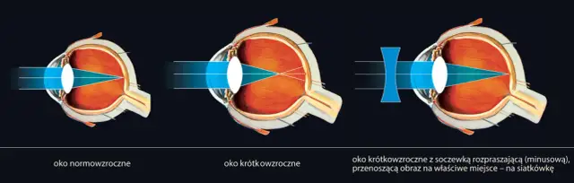 Krótkowzroczność: Soczewki, Orto-K, kontrola wady pełny przewodnik