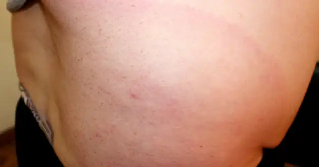 Obrzęk po kleszczu: Rumień wędrujący czy zwykła reakcja? Sprawdź!