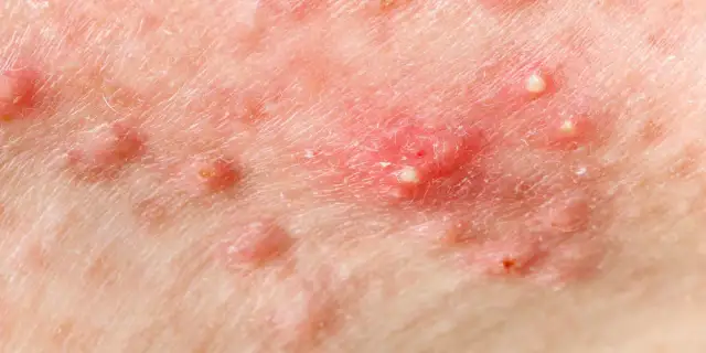 Ropny pryszcz? Poznaj sekrety gładkiej skóry bez blizn!