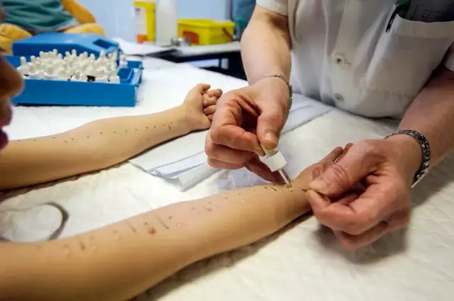 Jak wygląda badanie na alergie? Poznaj metody i ich przebieg