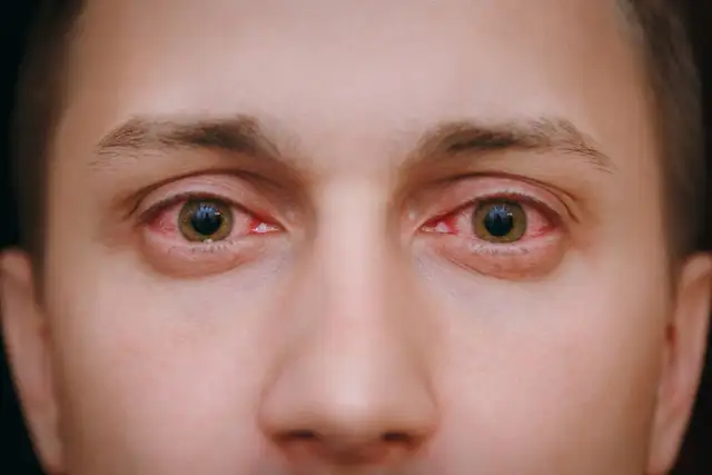 Przekrwione oczy przyczyny: poznaj, co może je powodować i jak leczyć