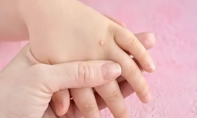 Skąd się biorą kurzajki? Poznaj przyczyny i skutki zakażenia HPV