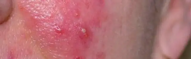 Zjawisko łojotoku: przyczyny, objawy i skuteczne metody leczenia