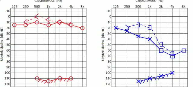 Audiogram - jak wygląda badanie słuchu i ile faktycznie trwa u specjalisty