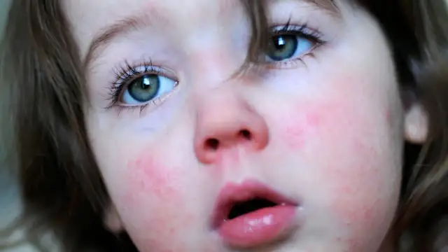 Jakie są objawy szkarlatyny u dziecka i co warto o nich wiedzieć?