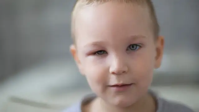 Co na opuchnięte oko u dziecka? Skuteczne sposoby i porady