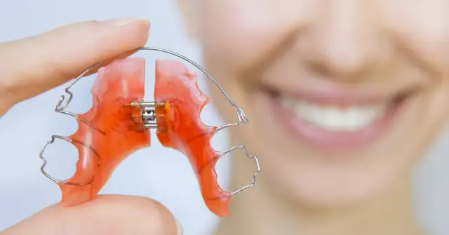 Ile naprawdę kosztuje zdejmowany aparat na zęby? Sprawdź, czy Cię stać!