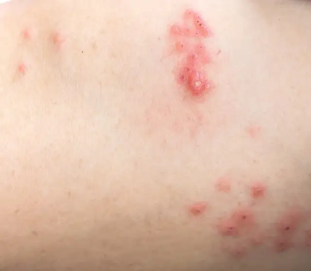 Jak wygląda półpasiec u dziecka? Objawy, które mogą cię zaskoczyć