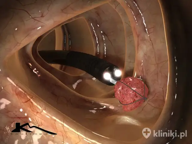 Czy kolonoskopia bada jelito cienkie? Sprawdź, co warto wiedzieć o badaniu jelit