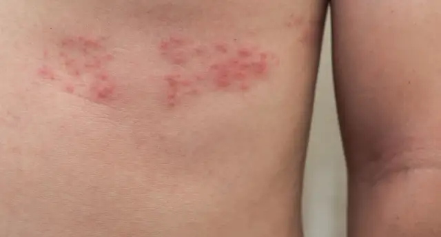Czerwona plama pod piersią: Jak leczyć czerwoną plamę pod piersią?