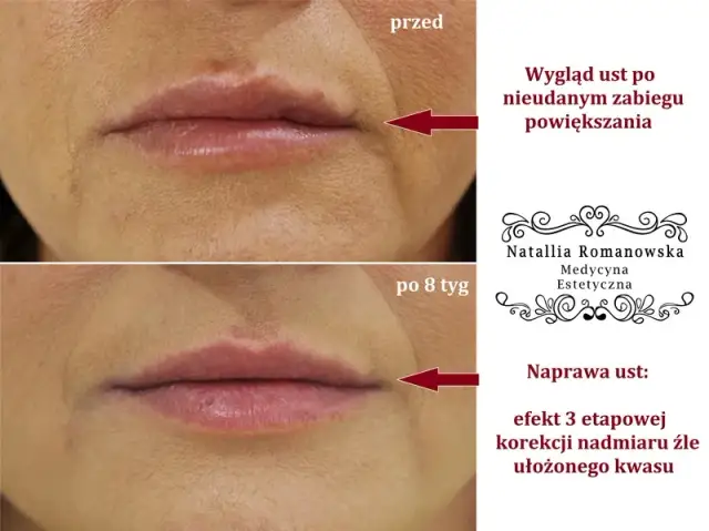 Czy można się całować po powiększaniu ust? Dowiedz się, co musisz wiedzieć