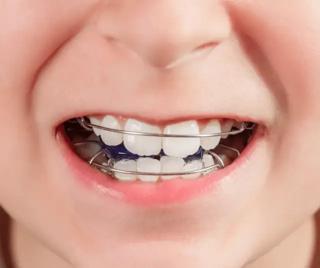 Jak wygląda ruchomy aparat na zęby dla dzieci? Wszystko, co musisz wiedzieć
