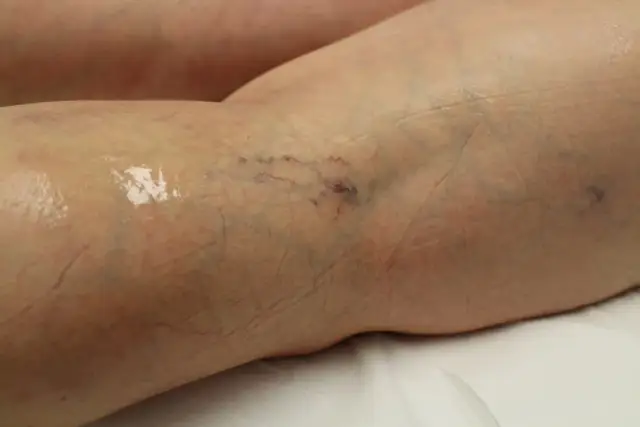 Skutki uboczne skleroterapii: najczęstsze problemy i poważne komplikacje