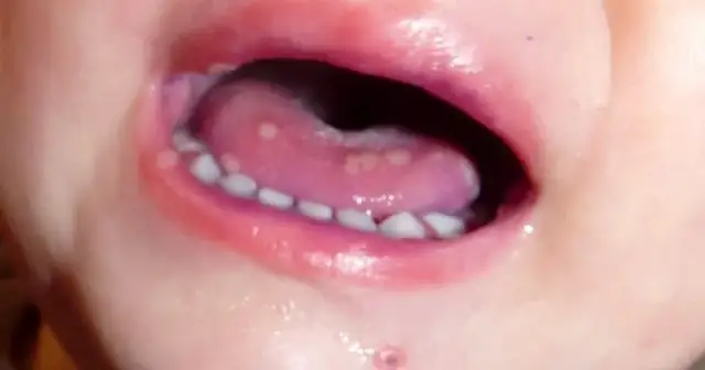 Objawy zapalenia jamy ustnej u dzieci – jak rozpoznać i złagodzić ból