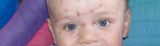 Kiedy ospa u niemowlaka wymaga pilnej wizyty w szpitalu? Objawy i porady
