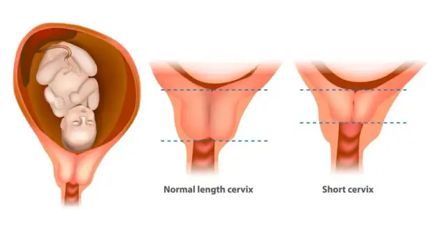 Ile przed porodem skraca się szyjka macicy? Kluczowe informacje dla przyszłych mam