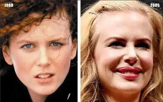 26 celebrytów których urodę zniszczyły operacje kosmetyczne i ich skutki