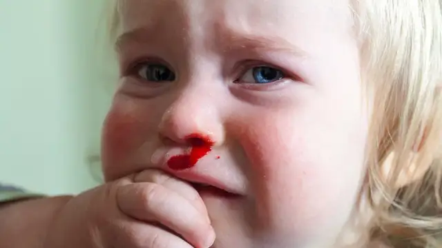 Czemu dziecku leci krew z nosa? Poznaj przyczyny i pomocne rady