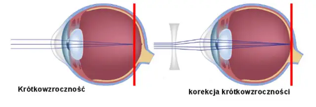 Jakie wady wzroku mogą się cofnąć? Fakty i skuteczne metody