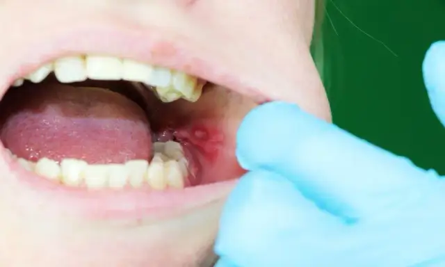 Dlaczego powstają afty w jamie ustnej? Przyczyny, zapobieganie i skuteczne leczenie