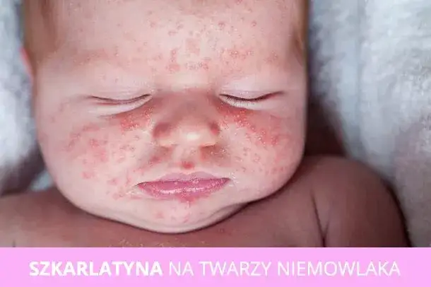 Objawy szkarlatyny u niemowlaka – jak rozpoznać i co robić?