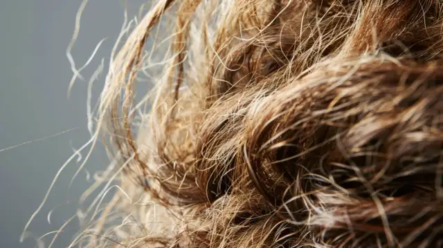 Kołtun choroba - przyczyny, objawy i metody leczenia